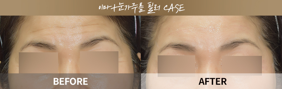 Filler forehead and crow’s feet before and after