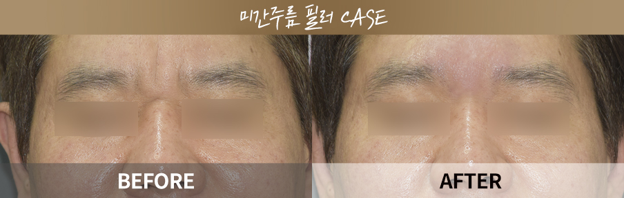 Glabella filler before and after