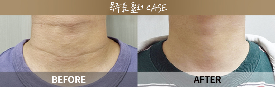 Neck wrinkle filler before and after