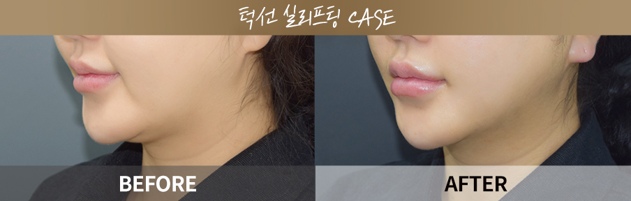 Jawline thread lifting before and after