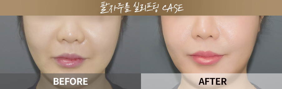 Smile line thread lifting before and after