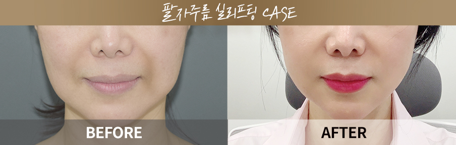 Smile line thread lifting before and after