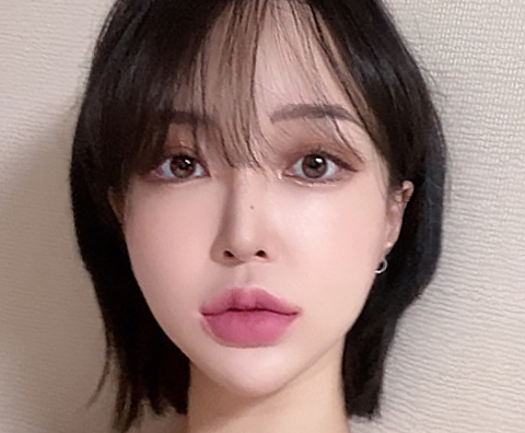 광대축소 수술 후