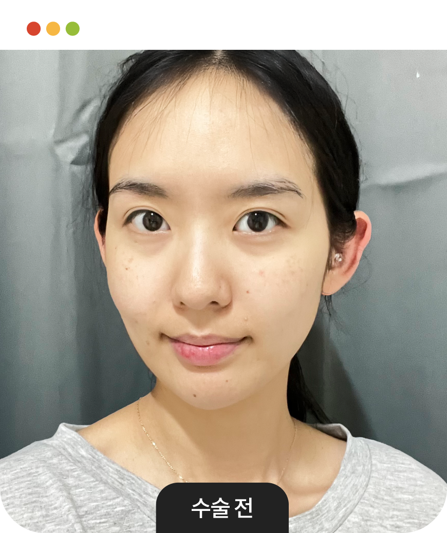 patient with slim facial contour after cheekbone reduction