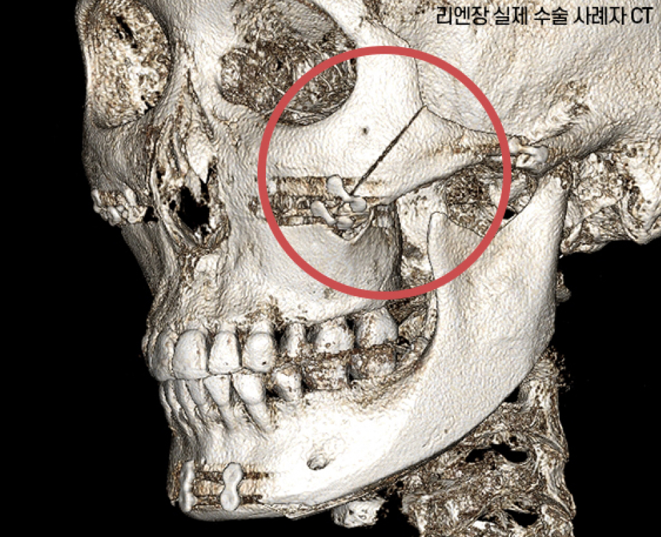 Photo of a skull after Lienjang's complete matching method of cheekbone reduction
