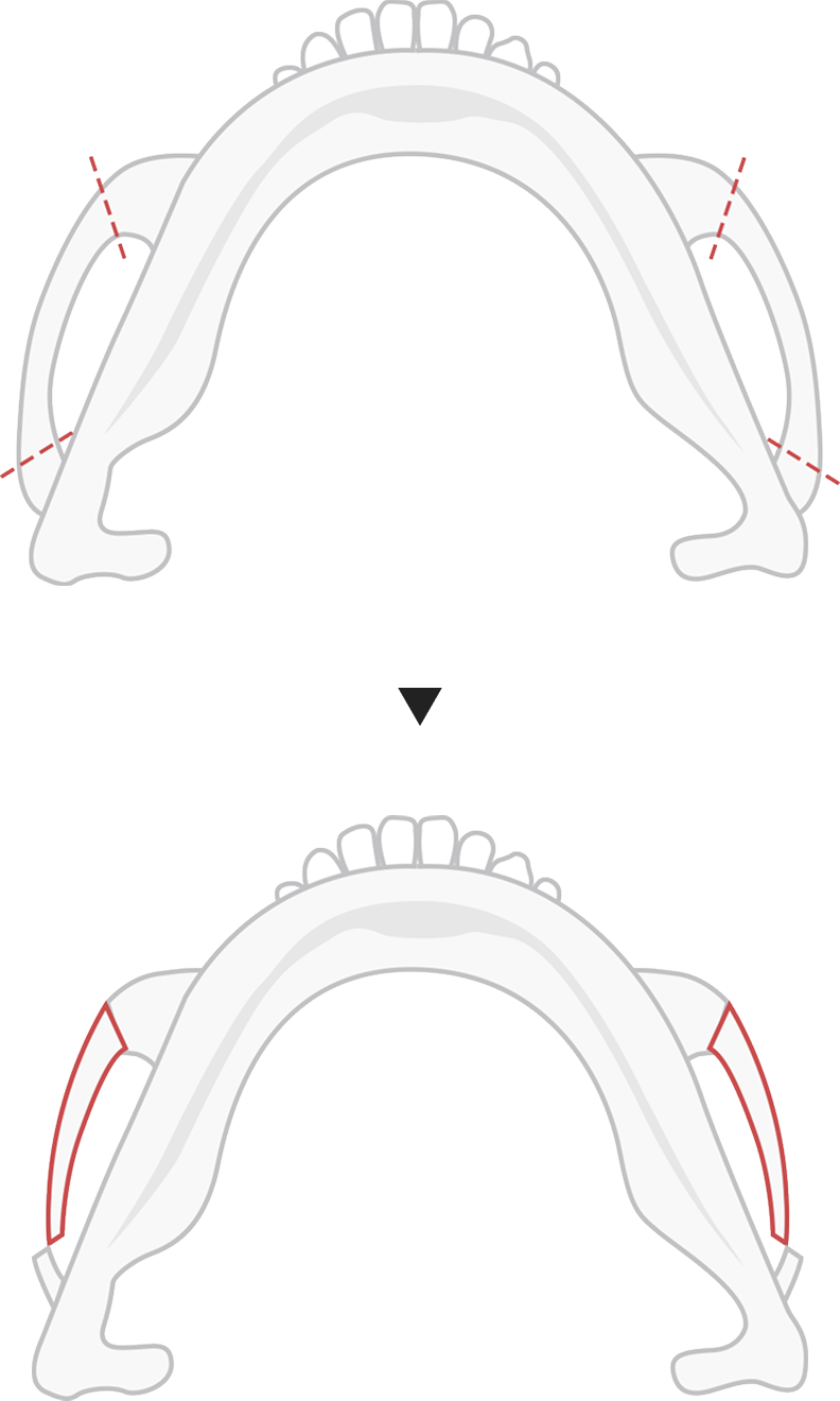 Type A cheekbone reduction method