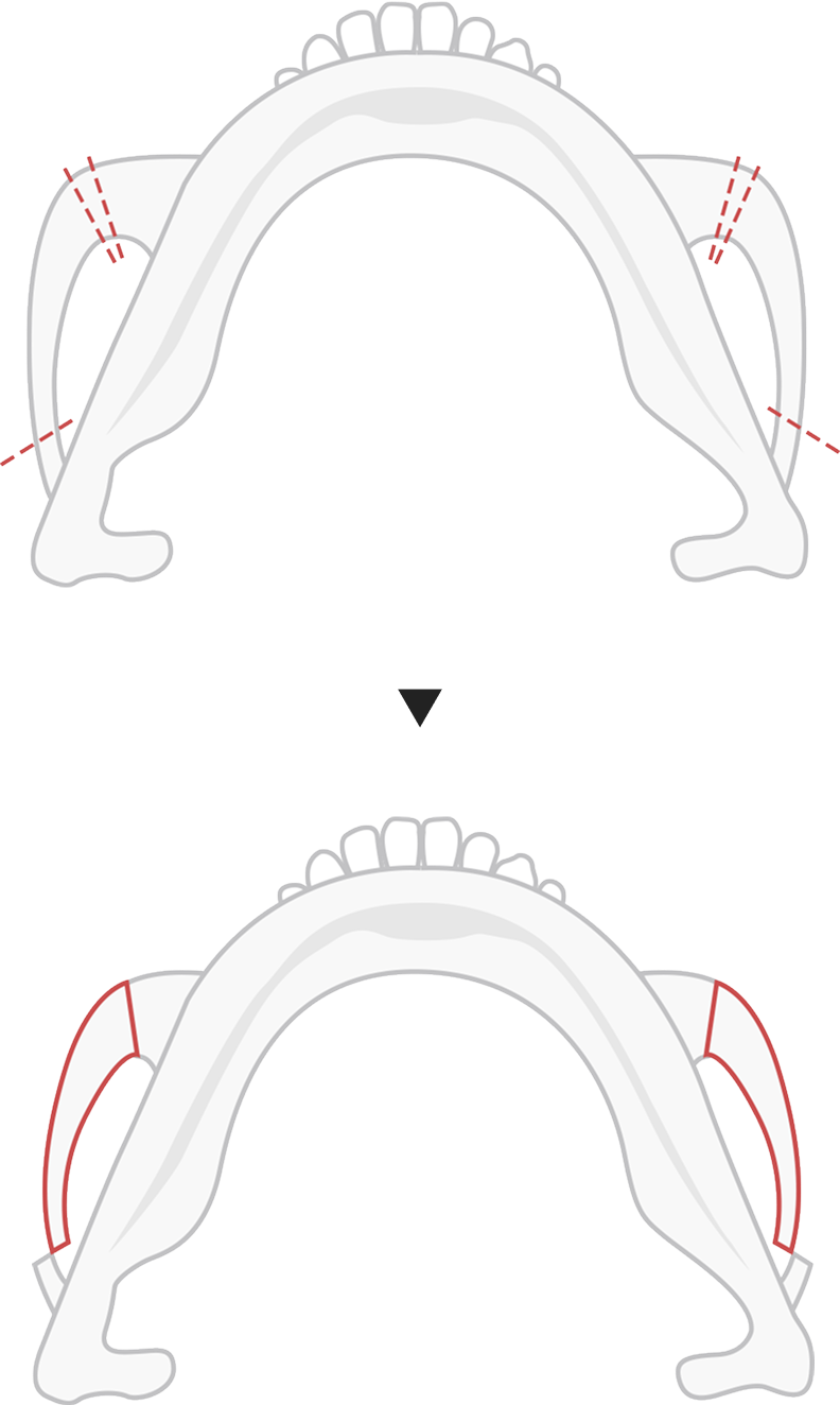 Type B cheekbone reduction method