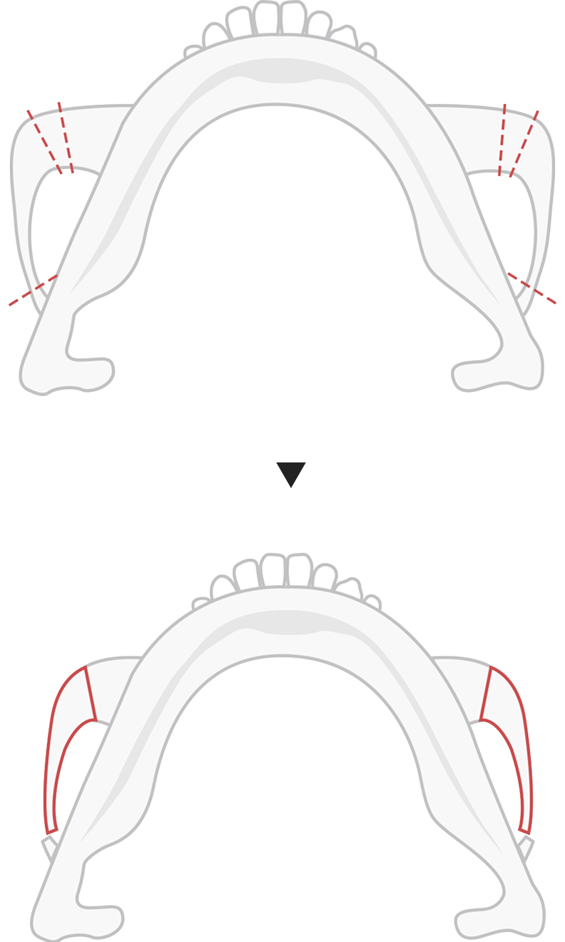 Type C cheekbone reduction method