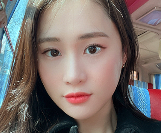 광대축소 수술 후
