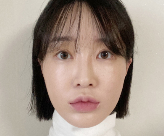 광대축소 수술 전