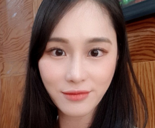 광대축소 수술 전