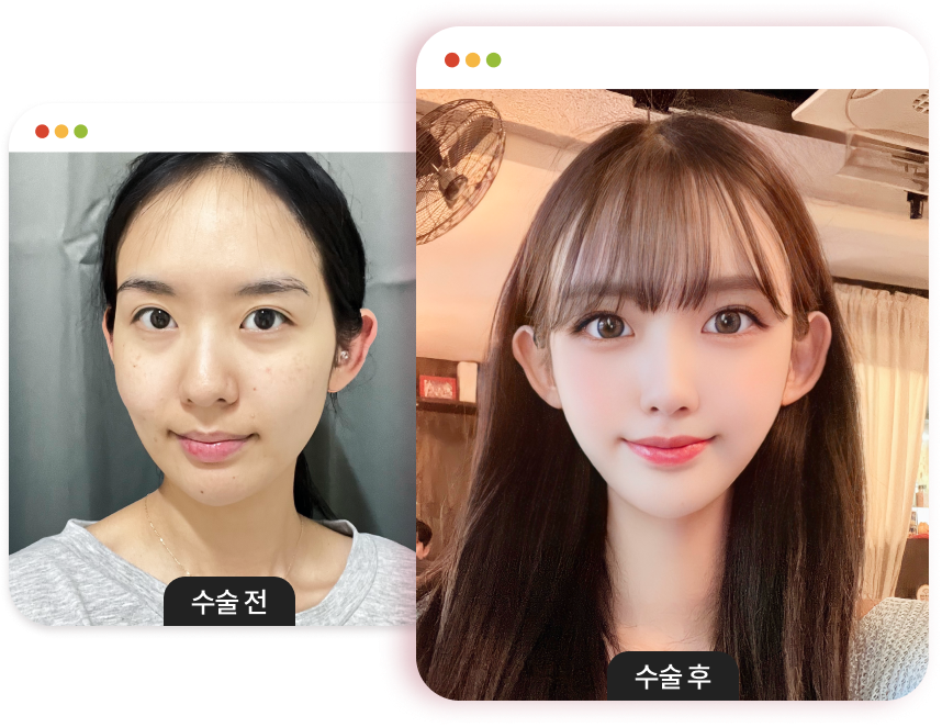 patient before cheekbone reduction
