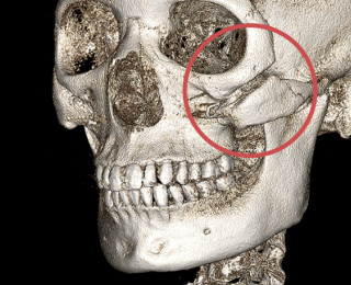 Photo of a skull after surgery with improper bone healing