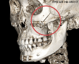 Photo of a skull after Lienjang's complete matching method of cheekbone reduction