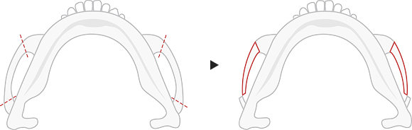 Type A cheekbone reduction method