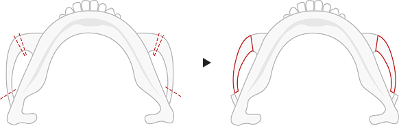 Type B cheekbone reduction method