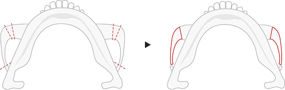 Type C cheekbone reduction method