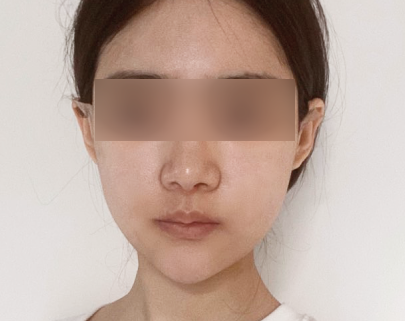 광대축소 3일 경과 사진