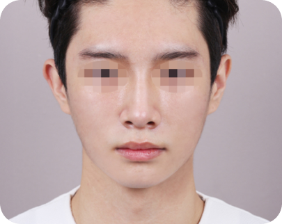 한달 경과 이미지