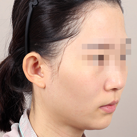 얼굴지방이식 수술 전 이미지