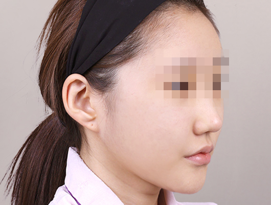 얼굴지방이식 수술 후 이미지