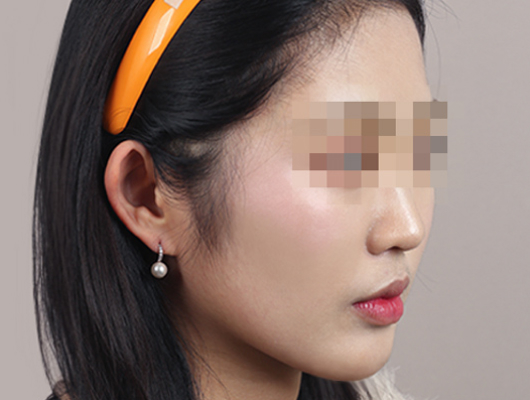 얼굴지방이식 수술 전 이미지
