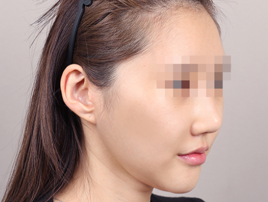 얼굴지방이식 수술 전 이미지