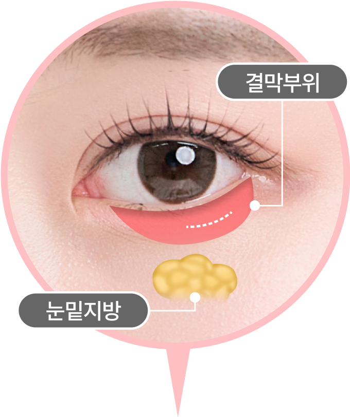 멍, 부기 최소화 해주는 눈 안쪽 결막 수술