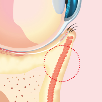 눈밑지방재배치 후 팽팽하게 고정된 안와격막