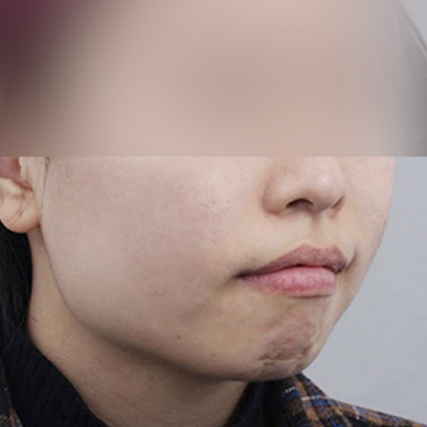 Rienjang acne scar care after mobile image 1