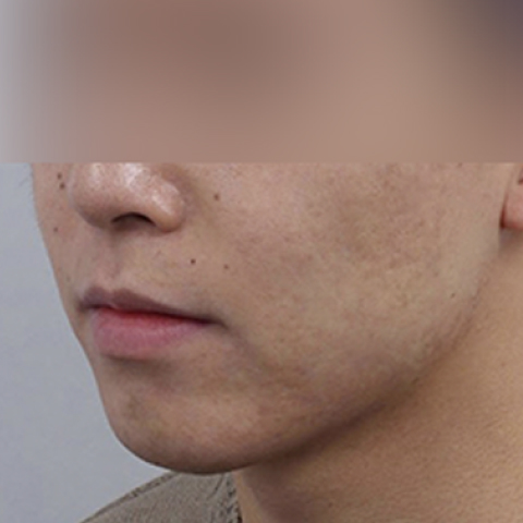 Rienjang acne scar care after mobile image 2