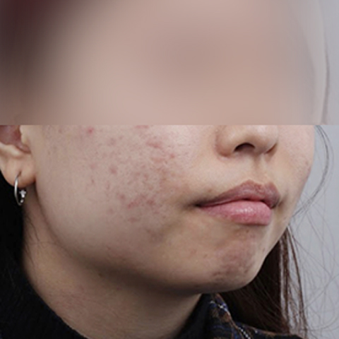 Rienjang acne scar care before mobile image 1