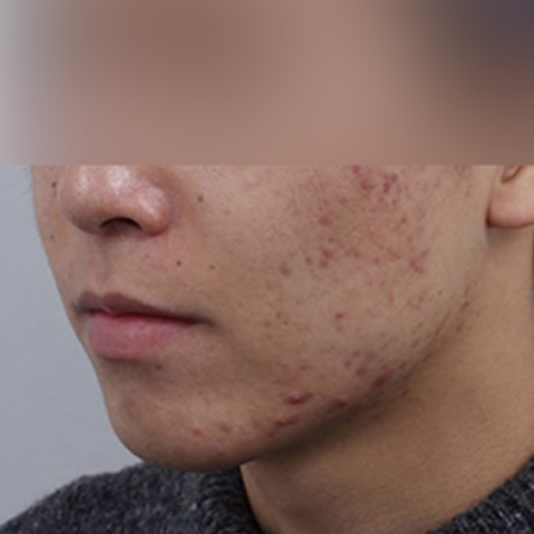Rienjang acne scar care before mobile image 2