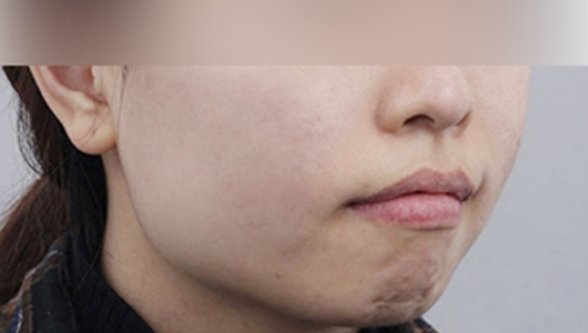 Rienjang acne scar care after image 1