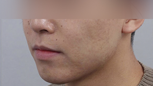 Rienjang acne scar care after image 2