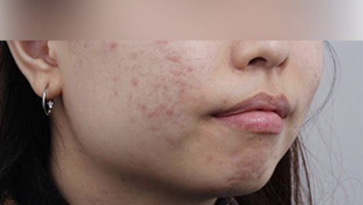 Rienjang acne scar care before image 1
