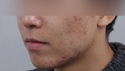 Rienjang acne scar care before image 2