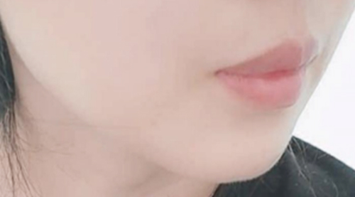 Double Chin After Treatment