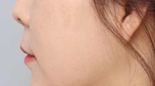 Perioral Wrinkles After Treatment