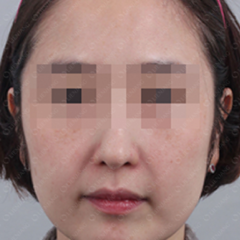 After Pigmentation Whitening Treatment Mobile 1