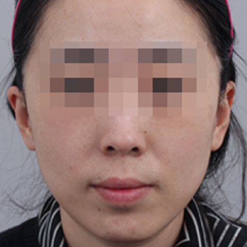 After Pigmentation Whitening Treatment Mobile 2