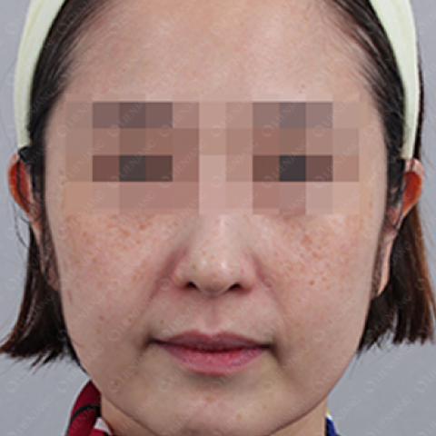 Before Pigmentation Whitening Treatment Mobile 1