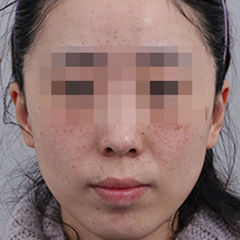Before Pigmentation Whitening Treatment Mobile 2