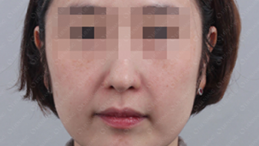 After Pigmentation Whitening Treatment 1