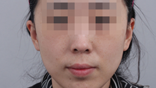 After Pigmentation Whitening Treatment 2