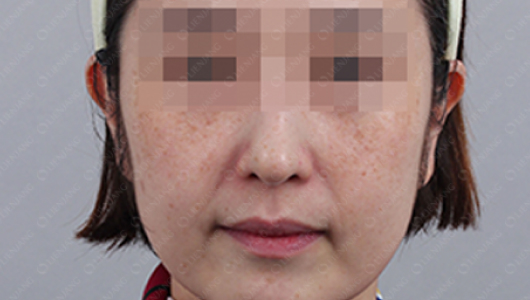 Before Pigmentation Whitening Treatment 1