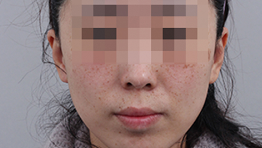 Before Pigmentation Whitening Treatment 2