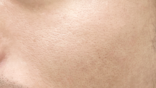 CoolFase Before Treatment Image 1