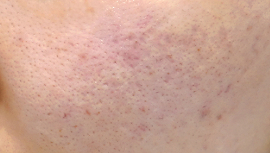 CoolFase Before Treatment Image 2