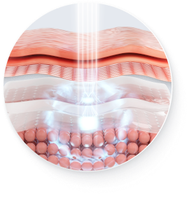 CoolFase Mobile Collagen Regeneration Principle Image